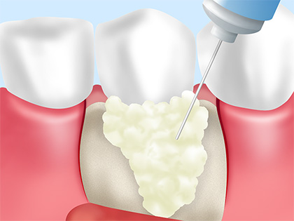 歯周再生療法（リグロス・エムドゲイン法）