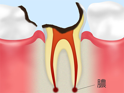 C4：歯根に達したむし歯