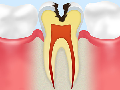 健康な歯の状態を保つために3ヶ月に一度の定期健診を推奨します